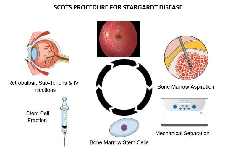 New Stargardt Disease Treatment Improves Vision